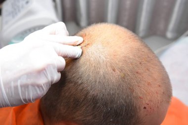 Kellik güzellik iğneleri ile tedavi. Mezoterapi. Plasmalifting.