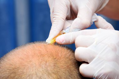 Kellik güzellik iğneleri ile tedavi. 