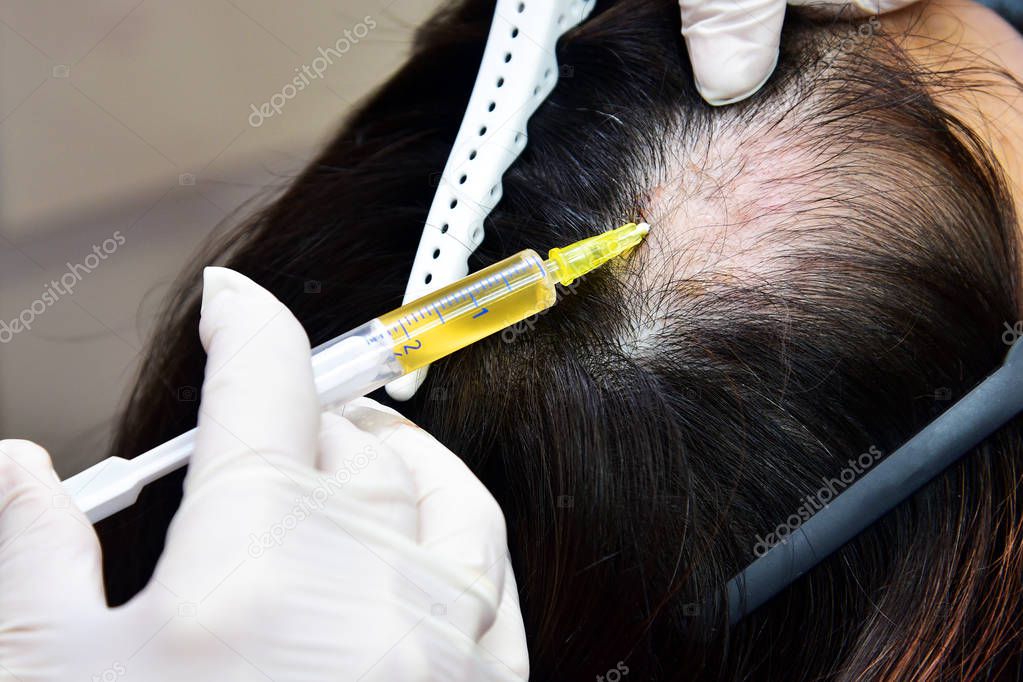 Treatment of baldness with beauty injections. 