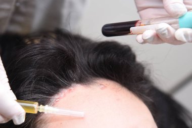 Sedef hastalığı. Baş kıllı parçası. Plazma enjeksiyon. Zabolivanie plazma insan kanı tedavisinde.