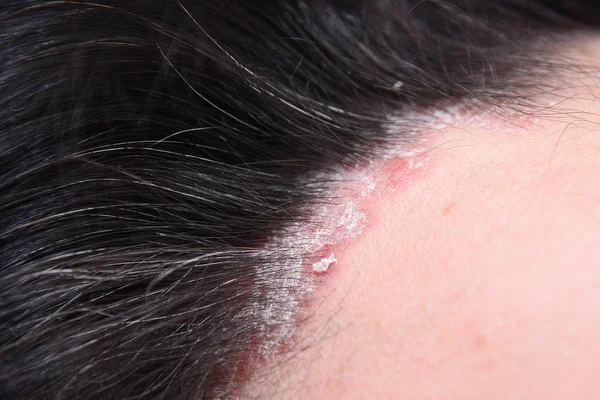 Schuppenflechte Haariger Teil Des Kopfes Plasmainjektion Behandlung Von Zabolivanie Plasma — Stockfoto
