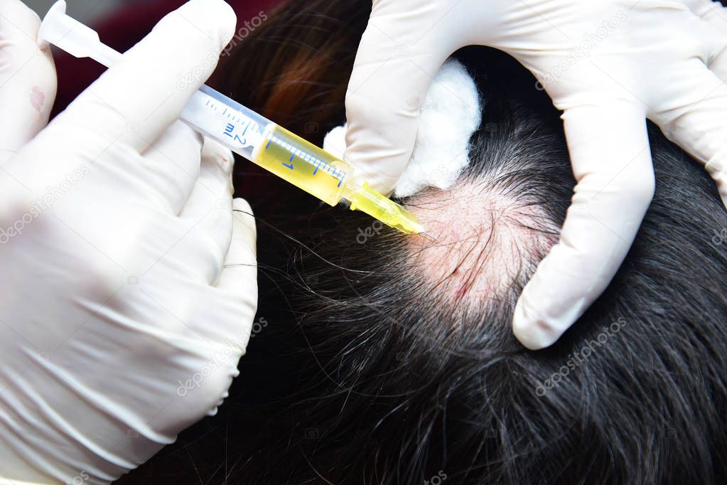 Treatment of baldness with beauty injections. Cosmetologist's hands in gloves make a subcutaneous injection.