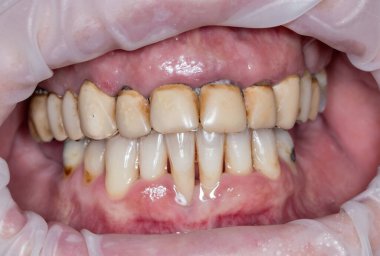 Kırık dişler, gülümseme, dişçide, yapay dişler..