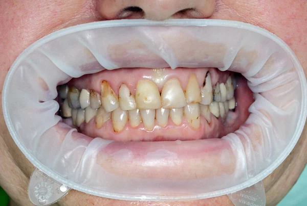 Dientes Rotos Sonrisa Dentista Dientes Artificiales —  Fotos de Stock