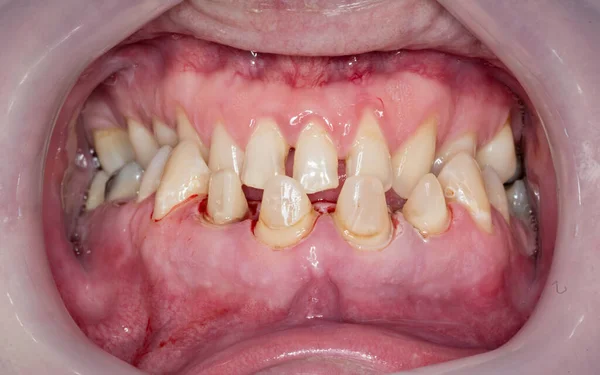 Caries Dientes Caídos Labios Boca Detalle Cara —  Fotos de Stock