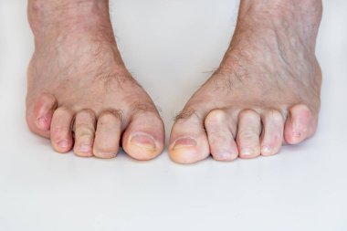 Çekiç ayak, bükülmüş ayak parmakları, anomali, hastalık.