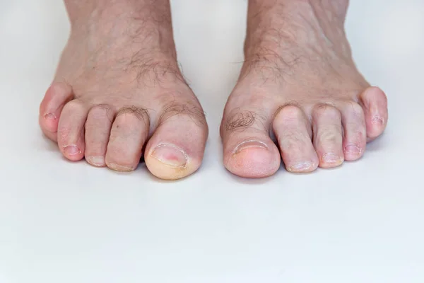 Hammer Toe Feet Bent Toes Anomaly Disease — Stock Photo, Image