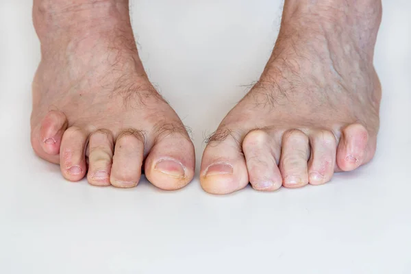 Çekiç ayak, bükülmüş ayak parmakları, anomali, hastalık.