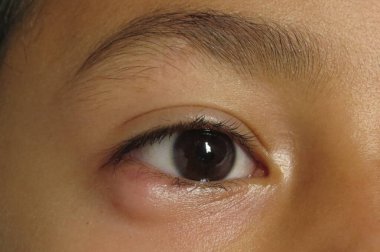 Outer view of nodule shaped style- chalazion on the lower eyelid of child. Papilledema ,selective focus. clipart