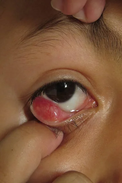 在血友病检查 特写的过程中 小男孩在眼睑上显示出一种粉刺 白内障 青光眼选择性病灶 — 图库照片