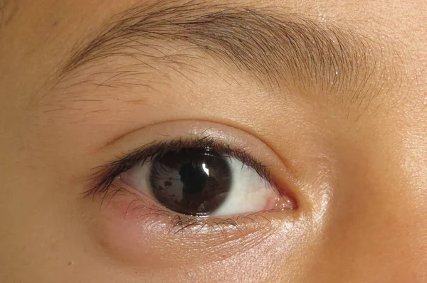 Außenansicht Des Knotenförmigen Stils Chalazion Auf Dem Unteren Augenlid Des — Stockfoto