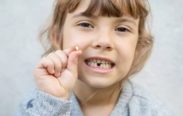 Il bambino aveva un dente da latte. Focus selettivo . — Foto Stock