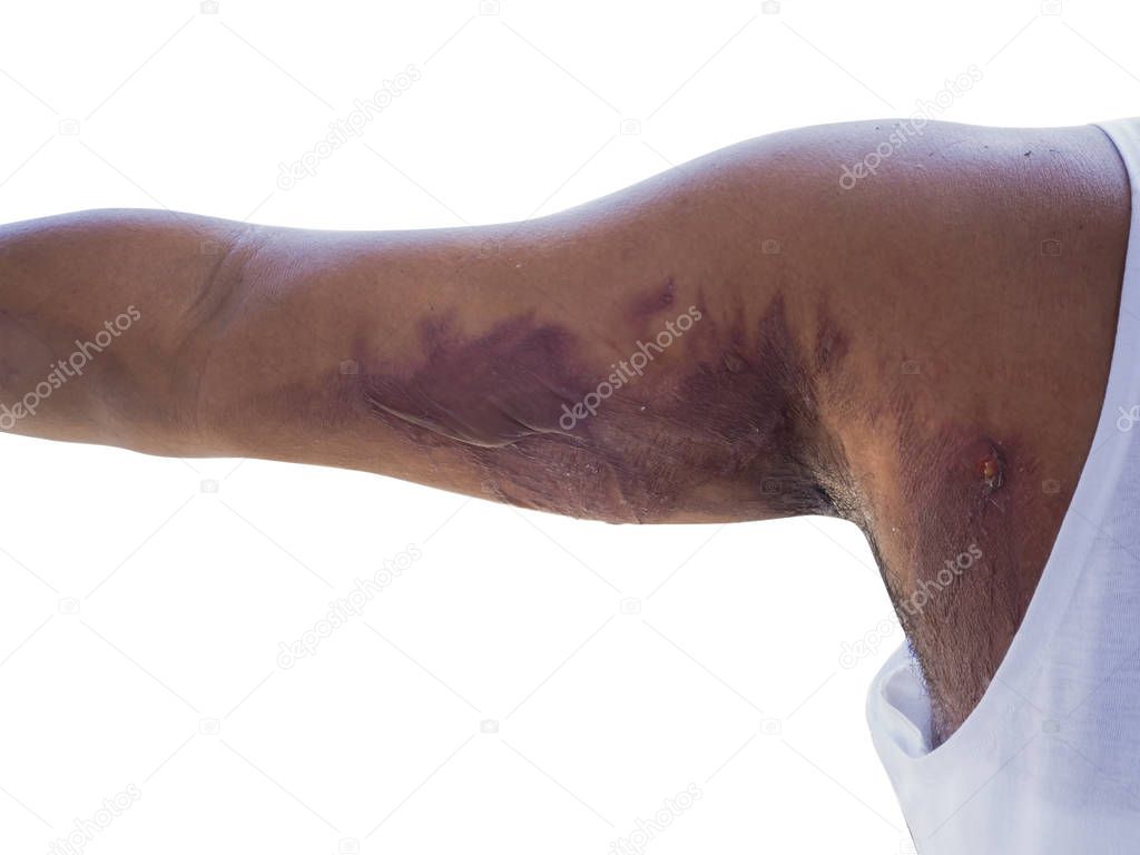 Wounds in the arm of a burning form accident scald  on a white background.