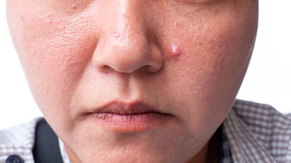 Nærbillede af rød hud med acnes - Stock-foto