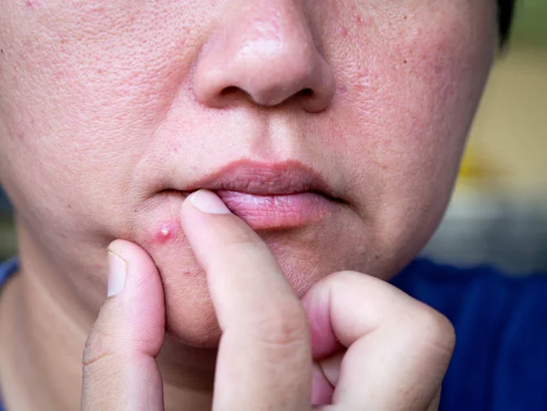 Acne i ansigtet - Stock-foto