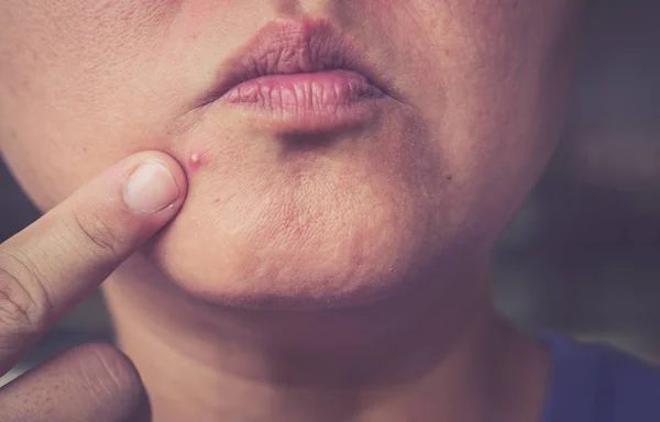 Acne on the face — Stock Photo, Image