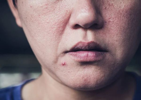 Acne skin — Stock Photo, Image