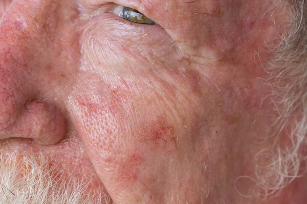 Old man needing treatment for basal cell carcinoma after an active lifetime in the sun in Queensland, Australia which has the highest rate of skin cancer.