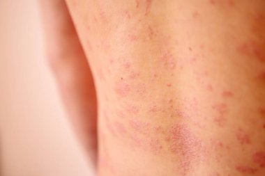 Sırtında ve kollarında sedef hastalığı olan bir adam. 