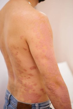 Sırtında ve kollarında sedef hastalığı olan bir adam. 