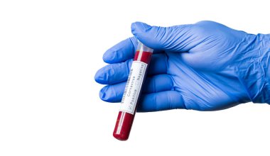 COVID19 SARS-CoV-2 Corona Virüs Kan Testi.