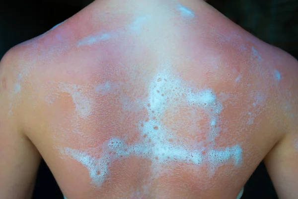 Sunburned girl with cooling foam on her back — Stock Photo, Image