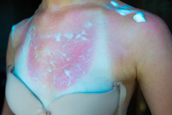 Sunburned girl with cooling foam on her neckline. — Stock Photo, Image