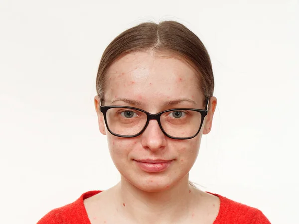 Πορτρέτο Του Ένα Κορίτσι Χωρίς Μακιγιάζ Ακμή Στο Πρόσωπο Λευκό — Φωτογραφία Αρχείου