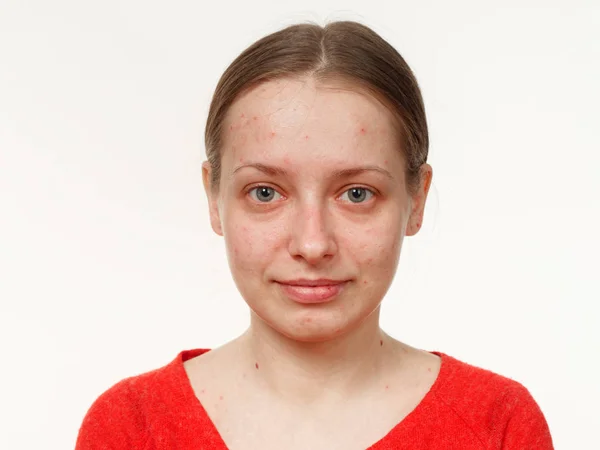 Πορτρέτο Του Ένα Κορίτσι Χωρίς Μακιγιάζ Ακμή Στο Πρόσωπο Λευκό — Φωτογραφία Αρχείου