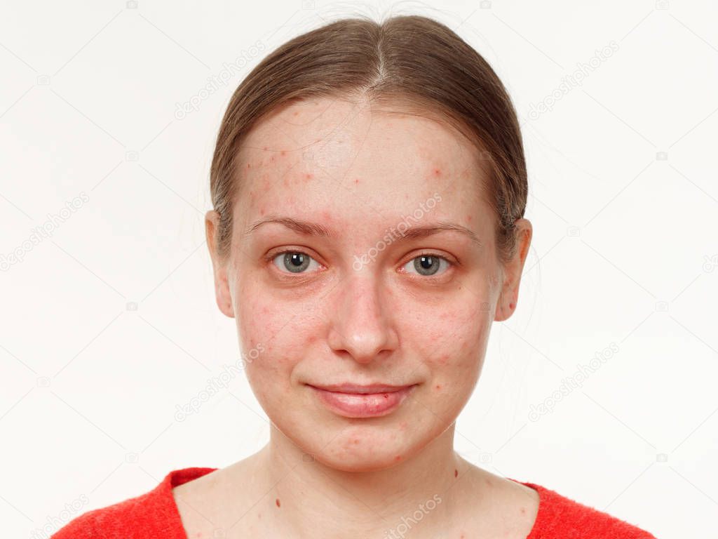 portrait of a girl without makeup. acne on the face. on a white background. 5