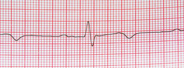 Elektrokardiyogram kaydı için kalp atış hızı, kalp hastalıklarının önlenmesi