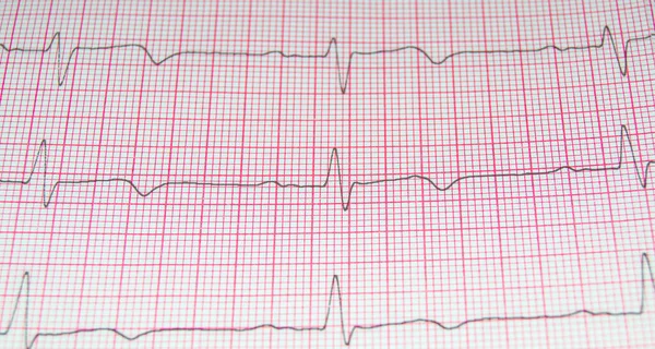 Elektrokardiyogram kaydı için kalp atış hızı, kalp hastalıklarının önlenmesi