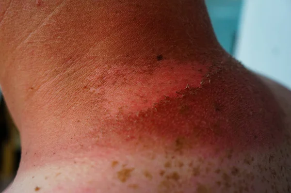 Bronzage Coups Soleil Sur Cou Décollement Peau Peau Rouge Délicate — Photo