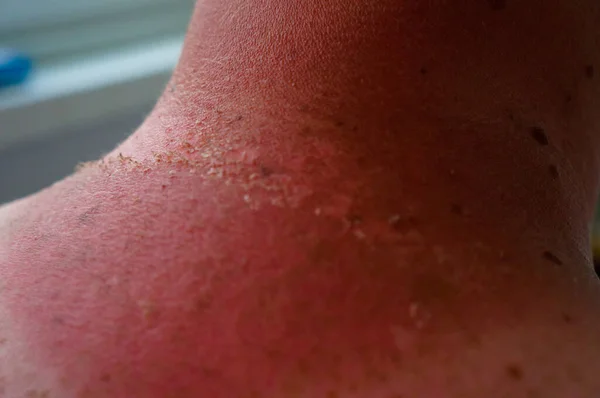 Bronzeado Queimadura Pescoço Descascando Pele Pele Vermelha Delicada — Fotografia de Stock