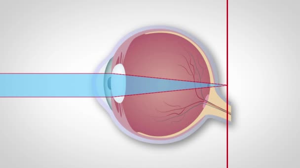 Schematic Representation Hyperopia Myopia Astigmatism Correction Various Eye Vision Disorders — Stock Video