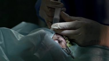 Ameliyattan önce anestezi lazer görme düzeltmesi, göz hekimliği ameliyatı, eldivenli cerrahın elleri lazer görme düzeltmesi, ameliyat gözü, katarakt ameliyatı.
