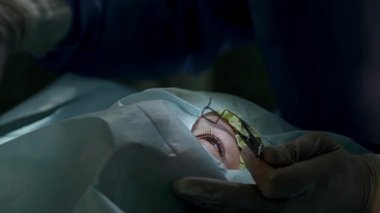 göz blepharostat, göz, katarakt cerrahisi, göz, göz doktoru ameliyathanede blepharostat operasyonunda Doktor setleri