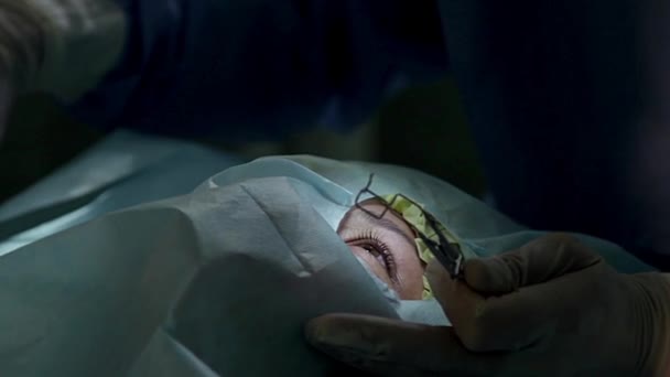 Blepharostat 白内障手術 眼科手術室で Blepharostat の操作上の医者セット — ストック動画