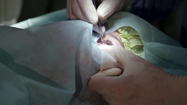 Arzt Setzt Auf Augenblepharostat Augenoperation Kataraktoperation Augenblepharostat Operationssaal — Stockvideo