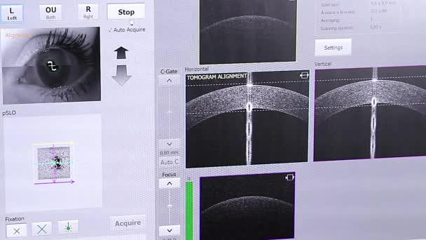 Lékař Pacient Oční Vyšetření Sledování Výsledků Monitoru Klinice Oftalmologické Vyšetření — Stock video