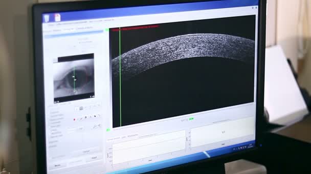 眼科检查的眼睛角膜在屏幕上的显示器 眼角在屏幕上的监视器 显示器在眼科与结果检查的病人 — 图库视频影像