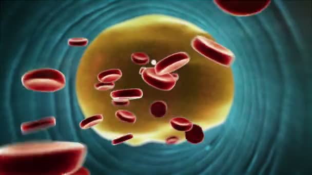 Жирні Бляшки Артерії Скорочення Кровоносних Судин Згусток Крові Судинах Жирові — стокове відео