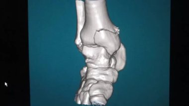 Ayak bileği bölgesinin çok dilimli spiral tomografisinin 3d Ses Düzeyi - Video 1