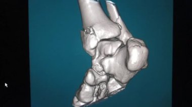 Ayak Bileği Bölgesi 'nin Çok Dilimli Spiral Tomografisinin 3d Ses Düzeyi - Video 2