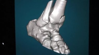 Ayak bileği bölgesinin çok dilimli sarmal tomografisinin 3d Volumetrik Resmi - Video 3