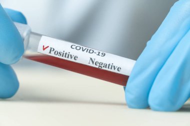 Doktorun mavi eldivenli ellerinde COVID-19 'a yakın çekim sonucu pozitif çıkan bir kan tüpü var. Teşhis konsepti