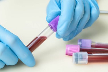 Tıbbi mavi eldiven test tüpündeki kadın eller klinik laboratuarında araştırma yapmak için yakın plan kan örneği ile birlikte. Tıp kavramı, analizler