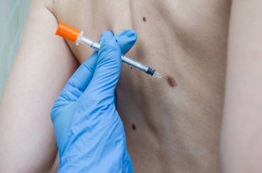 Doktor sırtındaki doğum lekesini inceliyor.