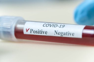 Doktorun mavi eldivenli ellerinde COVID-19 'a yakın çekim sonucu pozitif çıkan bir kan tüpü var. Teşhis konsepti