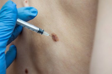 Doktor sırtındaki doğum lekesini inceliyor.